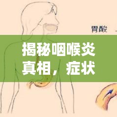 揭秘咽喉炎真相，症状解析、治疗方法和预防攻略全在这！百度独家呈现